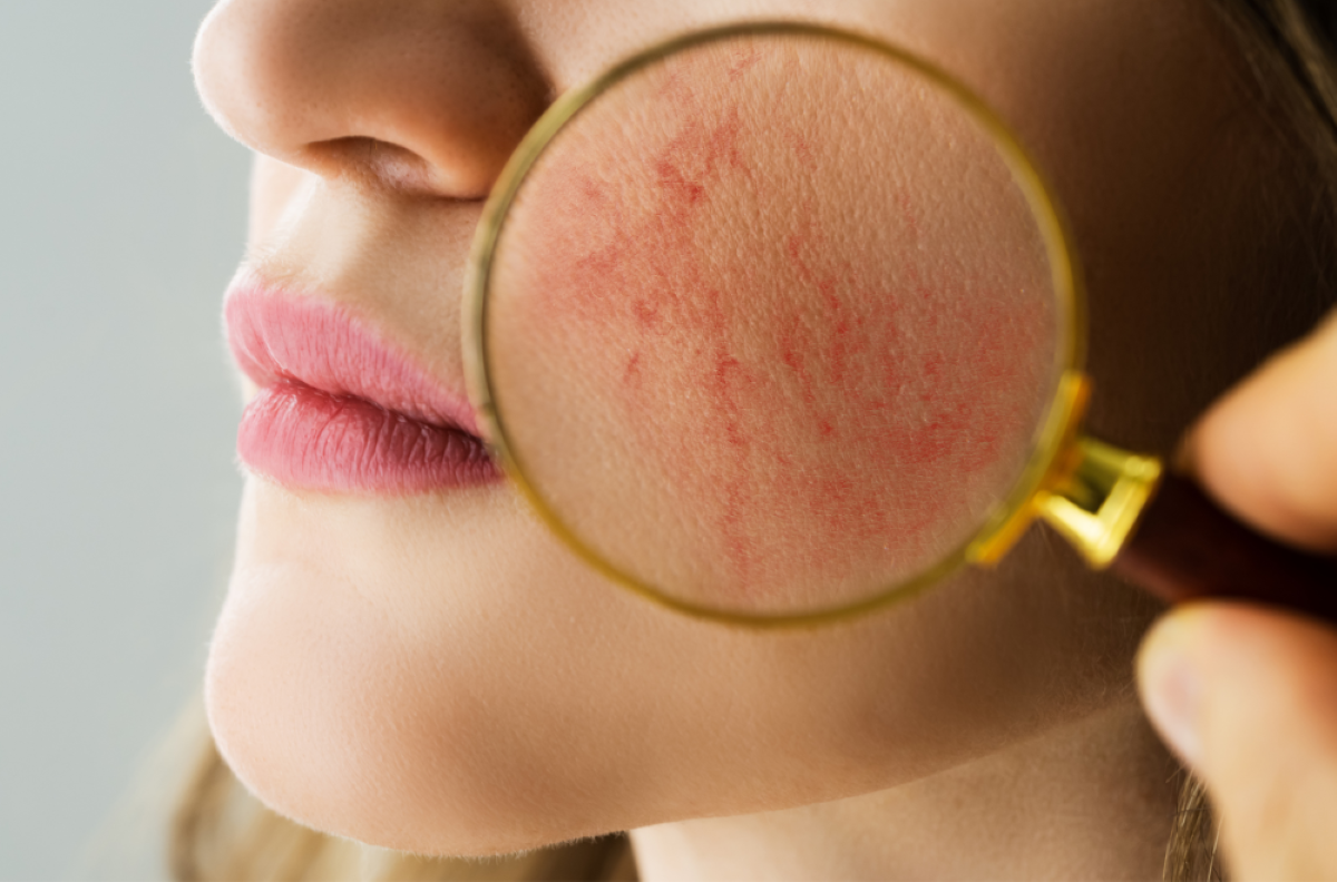 Rosacea